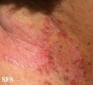 hailey-hailey disease