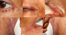 hailey-hailey disease