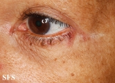 hailey-hailey disease