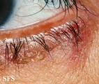 hailey-hailey disease