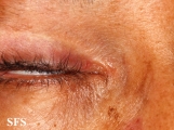 hailey-hailey disease