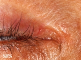 hailey-hailey disease