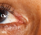 hailey-hailey disease