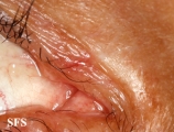 hailey-hailey disease