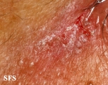 hailey-hailey disease