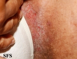 hailey-hailey disease