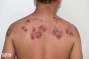 hailey-hailey disease