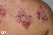 hailey-hailey disease