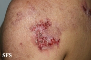 hailey-hailey disease