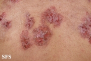 hailey-hailey disease
