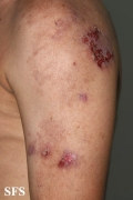 hailey-hailey disease