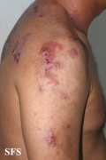 hailey-hailey disease
