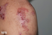 hailey-hailey disease