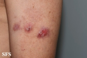 hailey-hailey disease