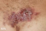 hailey-hailey disease