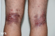 hailey-hailey disease