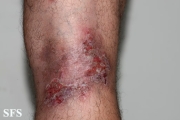 hailey-hailey disease