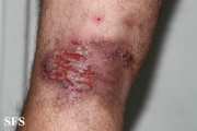 hailey-hailey disease
