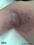 hailey-hailey disease