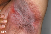 hailey-hailey disease