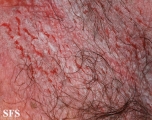 hailey-hailey disease