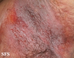 hailey-hailey disease