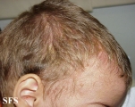 langerhans cell histiocytosis