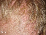 langerhans cell histiocytosis