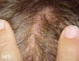 langerhans cell histiocytosis