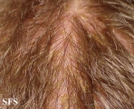 langerhans cell histiocytosis