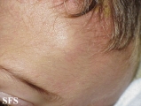 langerhans cell histiocytosis