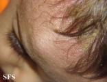 langerhans cell histiocytosis