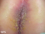 langerhans cell histiocytosis