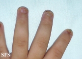 langerhans cell histiocytosis