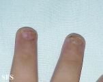 langerhans cell histiocytosis