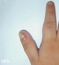 langerhans cell histiocytosis