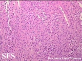 langerhans cell histiocytosis