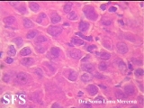 langerhans cell histiocytosis