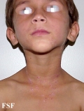 lichen planus actinicus