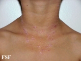 lichen planus actinicus