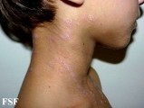 lichen planus actinicus