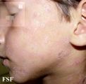 lichen planus actinicus