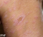 lichen planus actinicus