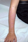 lichen planus actinicus