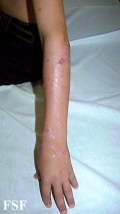 lichen planus actinicus