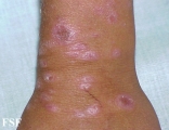 lichen planus actinicus