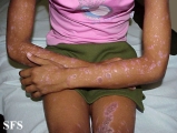 lichen planus actinicus