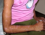 lichen planus actinicus