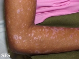 lichen planus actinicus