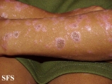 lichen planus actinicus